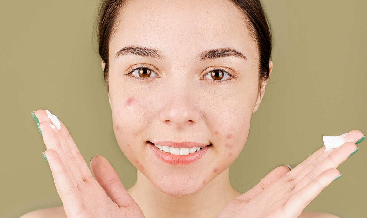 Combattere acne e cicatrici con le migliori creme per pelli grasse