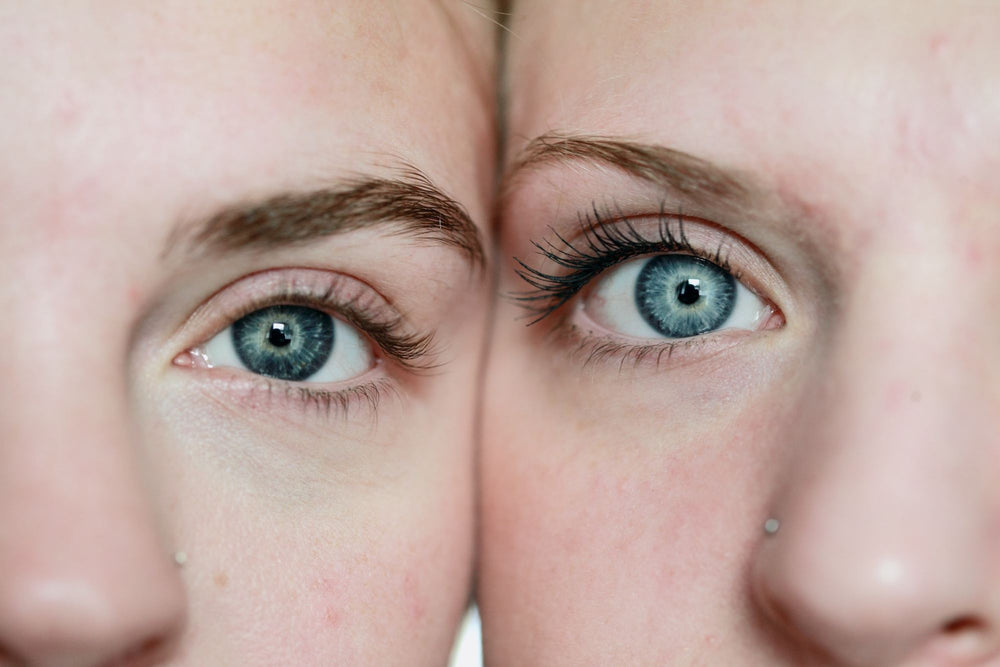 rosacea sul viso cause e rimedi