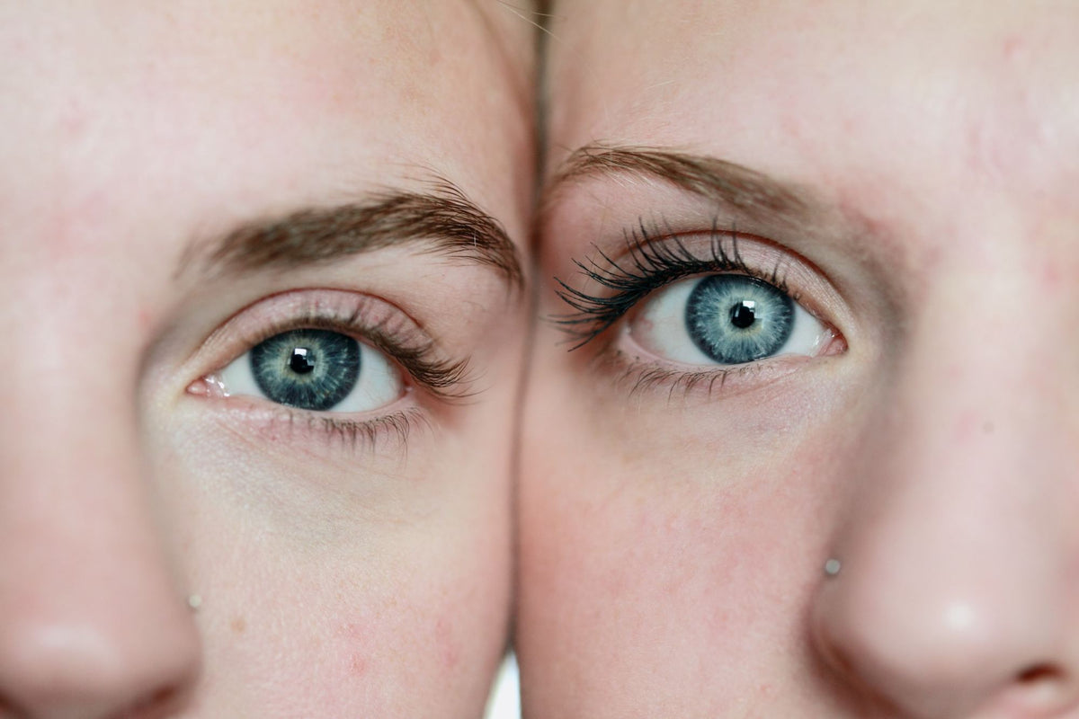 Pelle con rosacea: rimedi per viso, guance e arrossamento